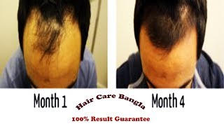 Homeopathic Medicine For Alopecia and Baldness  Hair Care Bangla [upl. by Leyla68]