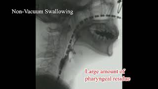 Swallowing with nonvacuum and vacuum [upl. by Avie]