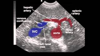 Abdominal Aortic Aneurysm AAA Ultrasound [upl. by Aikkan167]