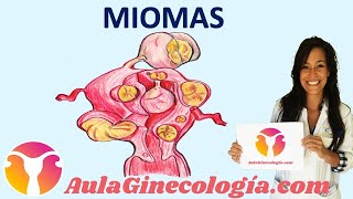 MIOMAS Síntomas diagnóstico y tratamiento de los miomas  Ginecología y Obstetricia [upl. by Nitfa874]