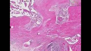 Histopathology ThyroidHashimoto thyroiditis papillary car [upl. by Naujed520]