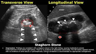 Kidney Ultrasound Reporting  Renal Diseases Scan Reports  How To Write USG Report  KUB USG [upl. by Siurad]