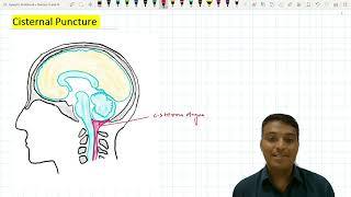 Cisternal Puncture  Suboccipital Puncture [upl. by Ravel]