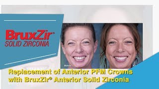 Replacement of Anterior PFM Crowns with BruxZir Anterior Solid Zirconia Crowns [upl. by Catima748]