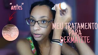 COMO TRATEI MINHA DERMATITE SEBORREICA  PRODUTOS [upl. by Eemiaj]