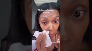 Chalazion surgery Part 4 chalazion surgeryday eyedoctor eyesurgery stye [upl. by Esinyl]