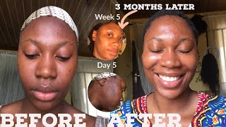 KOJIE San kojic ACID skin lightening Soap  3 Months Updated Review with before and after videos [upl. by Idnir493]