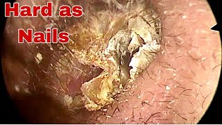 Hard as Nails Earwax Removal  Doctor Anh [upl. by Skipton591]