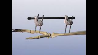 Distal Radius External Fixator for multifragmentary fractures [upl. by Hametaf]