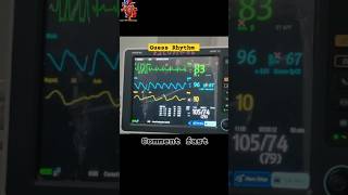 VPC In ECG venticular ectopic heartknowledge cathlab ytshorts ecg [upl. by Zeugirdor]