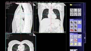 HRCT Scan Chest Techniq amp Filming [upl. by Miof Mela]