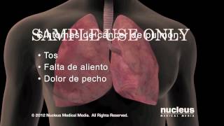 Síntomas del cáncer de pulmón [upl. by Chow]