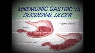 MNEMONIC GASTRIC ULCER VS DUODENAL ULCERmedicinelectures medicineeducationtalks medilectures [upl. by Eanwahs]