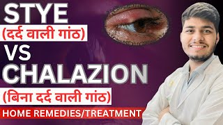 Stye vs chalazion  Difference between stye and chalazion [upl. by Maise279]