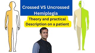 Crossed vs uncrossed hemiplegia pediatrics neurology [upl. by Zilber]