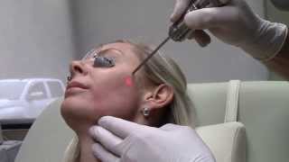 Dr Seiler using Fotona QSwitch Laser for Pigment on Face [upl. by Ahsilrae527]