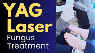 YAG Laser Treatment for Toenail Fungus Nd YAG Laser Before and After [upl. by Vaas]