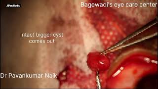 Implanted conjunctival cystyoung boyintoto excision [upl. by Chicky322]