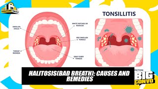 Halitosis Causes Effects And It’s Treatment [upl. by Hoover357]