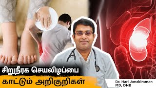 Kidney Failure Symptoms in Tamil  Warning Signs and Symptoms of Kidney Disease Salem Gopi Hospital [upl. by Babcock548]