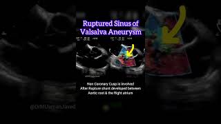 Ruptured Sinus of Valsalva Aneurysm echocardiography echocardiogram cardiology lcx [upl. by Aizti]