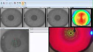 Corneal topography [upl. by Zucker]