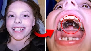 Getting an EXPANDER… how does expander work  Orthodontist explains [upl. by Enom]