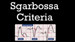 Modified Sgarbossa Criteria  ECG [upl. by Inaoj]