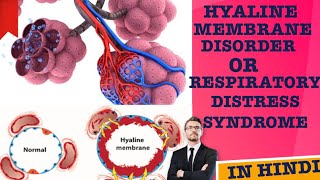 HYALINE MEMBRANE DISORDER OR RESPIRATORY DISTRESS SYNDROME what happened in alveoli let’s see [upl. by Dennard686]