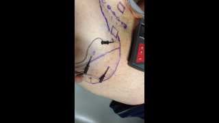 Electrical Dry Needling to Trigger Points in the Gluteus Medius and Minimus Muscles [upl. by Dnalrag]