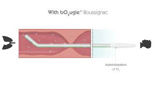 Bougie Boussignac for difficult intubation  Vygon [upl. by Emaj]