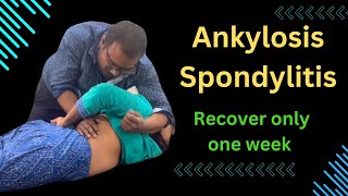 Ankylosis Spondylitis Recover Only One Week ankylosing spondylitis symptoms treating ankylosing [upl. by Tattan61]