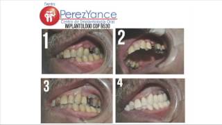 CASOS CLÍNICOS Dental Perez Yance Parte 2 [upl. by Tsui]