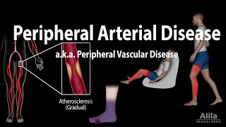 Peripheral artery disease Pathophysiology Causes Symptoms Diagnosis and Treatments Animation [upl. by Narib552]