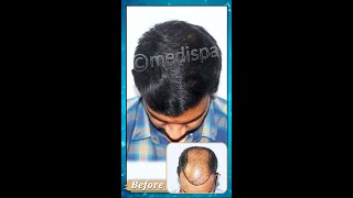 Medispa Hair Transplant Results after 9 months and Cost [upl. by Resaec829]