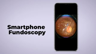 Smartphone Fundoscopy turn any smartphone into fundus camera [upl. by Adnoluy]