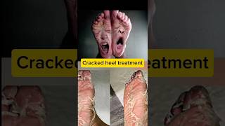 CRACKED HEELS  SKIN CARE TIPS  HEEL FISSURES  CRACKED FEET  FOOT CARE  SKIN CARE viral [upl. by Noskcaj]