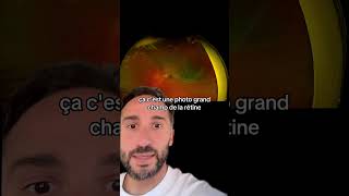 Décollement de rétine retine ophtalmologie sante medecine urgence youtubeshorts ytshorts [upl. by Akcebar]