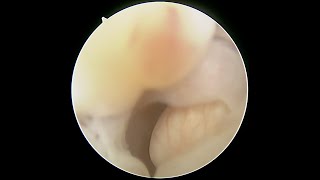 Cervical and uterine polyp with Ashermans adhesions [upl. by Tartaglia420]