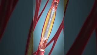 procedure of angioplasty shorts viralshorts [upl. by Virnelli]