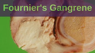 What is Fourniers Gangrene  Pathology mini tutorial [upl. by Hebner]