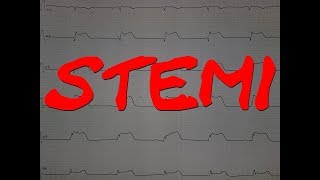 PCI of STElevation Myocardial Infarction STEMI  Cardiology Forum [upl. by Pros231]