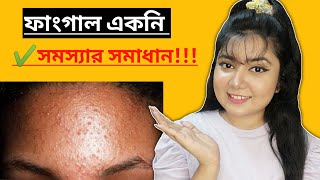 ফাংগাল একনি দূর করার উপায়  Fungal Acne Safe Skincare Products  MAKEUP MISTRESS [upl. by Adnilasor]