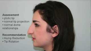 Tip Rotation amp Hump Reduction Rhinoplasty Case Study  Dr Buonassisi 8 West Clinic in Vancouver [upl. by Nwahsiek]