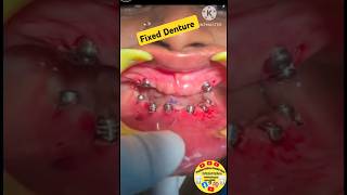 Stunning full mouth implants with ceramics implants smile dentistry piercingsatisfying [upl. by Ahsekad]