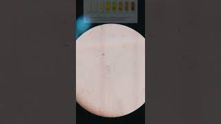 🎥Trichomoniasis Trichomonas in urine under 🎥📲Microscope Its Symptoms and sign With treatment [upl. by Taggart]