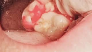 akad daal kaise nikale third molar and 7 number molar exceptiondentition [upl. by Quent107]