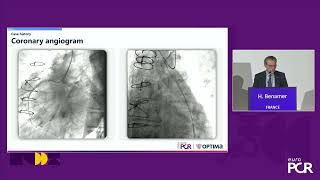 Relief for the unrelievable the role of the Reducer for refractory angina  EuroPCR 2024 [upl. by Smail]