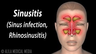 Sinusitis Animation [upl. by Gearhart]