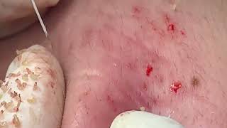 Popping Tons Of Blackheads Part 382 [upl. by Llennej]